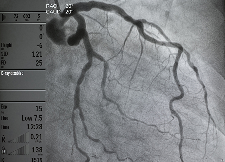 coronary angiography